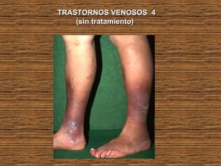 TRASTORNOS VENOSOS 4TRASTORNOS VENOSOS 4
(sin tratamiento)(sin tratamiento)
 