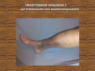 TRASTORNOS VENOSOS 2TRASTORNOS VENOSOS 2
(en tratamiento con elastocompresión)(en tratamiento con elastocompresión)
 