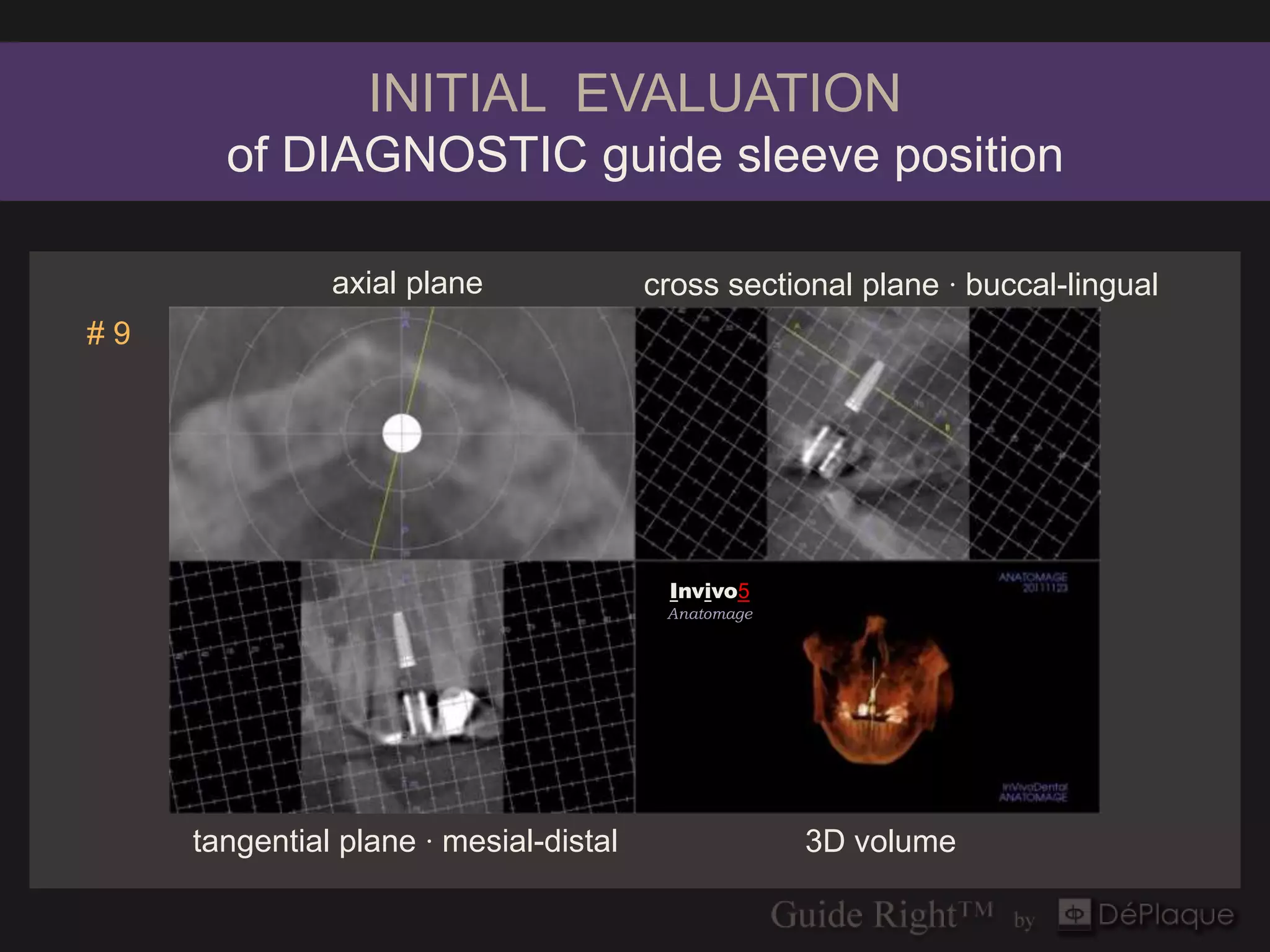INITIAL EVALUATION
       of DIAGNOSTIC guide sleeve position

               axial plane              cross sectional plane · buccal-lingual
#9




                                         Invivo5
                                         Invivo5
                                         Anatomage
                                         Anatomage




     tangential plane · mesial-distal                3D volume
 