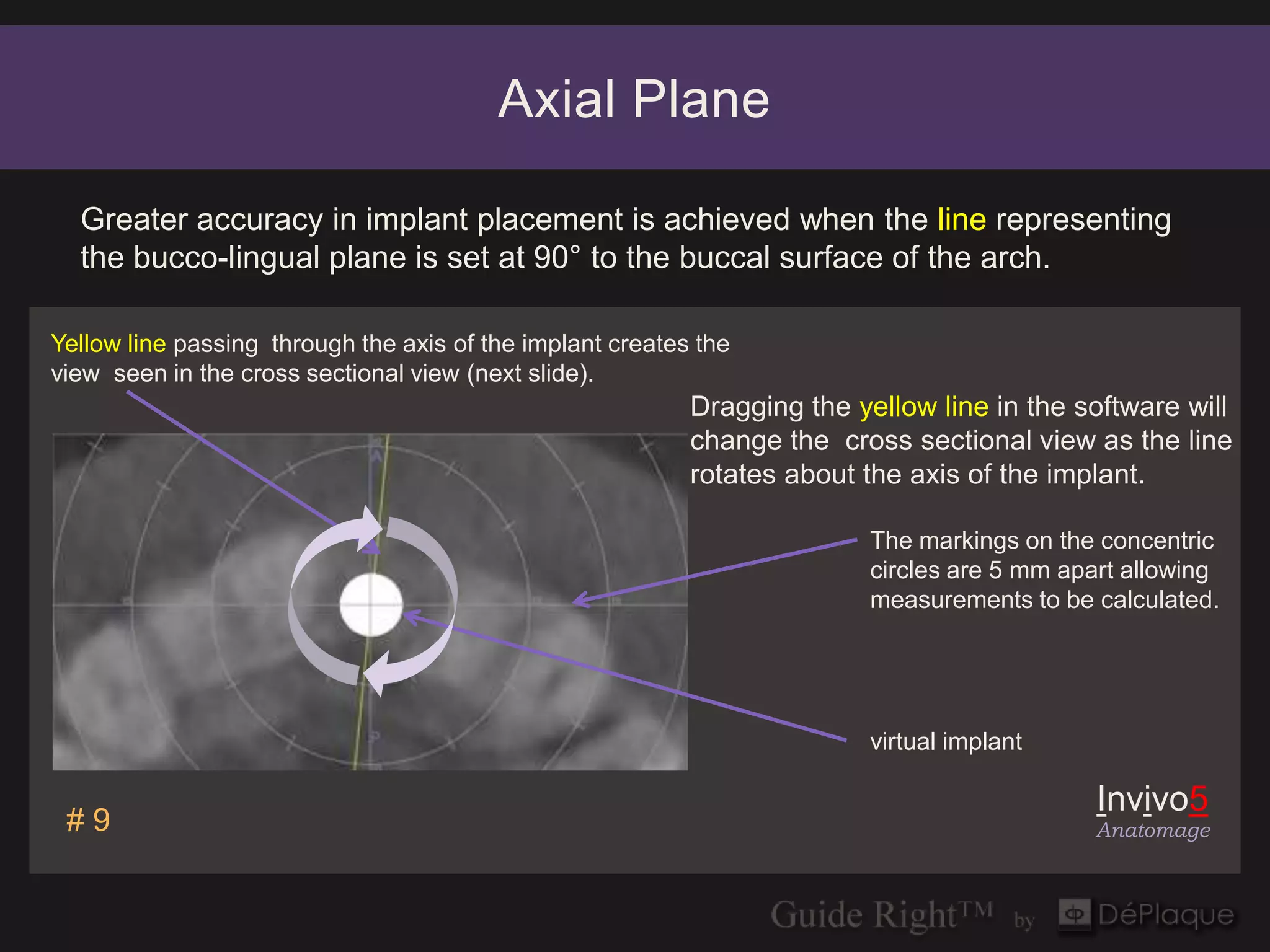 Axial Plane

  Greater accuracy in implant placement is achieved when the line representing
  the bucco-lingual plane is set at 90° to the buccal surface of the arch.

Yellow line passing through the axis of the implant creates the
view seen in the cross sectional view (next slide).
                                                           Dragging the yellow line in the software will
                                                           change the cross sectional view as the line
                                                           rotates about the axis of the implant.

                                                                         The markings on the concentric
                                                                         circles are 5 mm apart allowing
                                                                         measurements to be calculated.




                                                                         virtual implant

                                                                                             Invivo5
 #9                                                                                          Anatomage
 