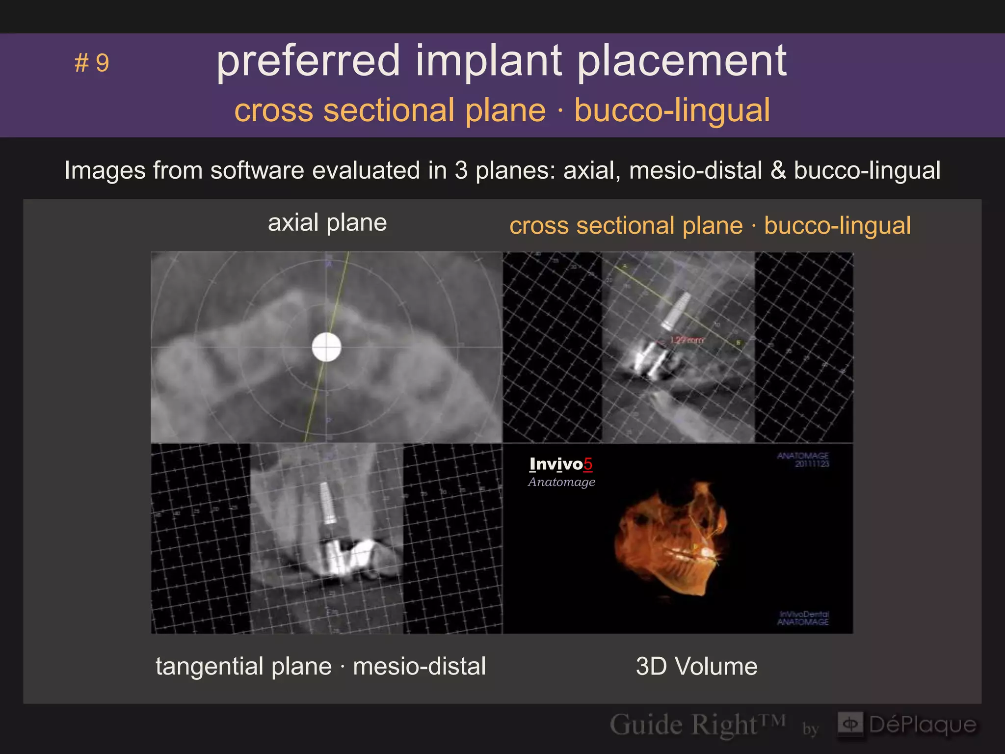 #9           preferred implant placement
               cross sectional plane · bucco-lingual
Images from software evaluated in 3 planes: axial, mesio-distal & bucco-lingual

                  axial plane             cross sectional plane · bucco-lingual




                                           Invivo5
                                           Anatomage




        tangential plane · mesio-distal                3D Volume
 