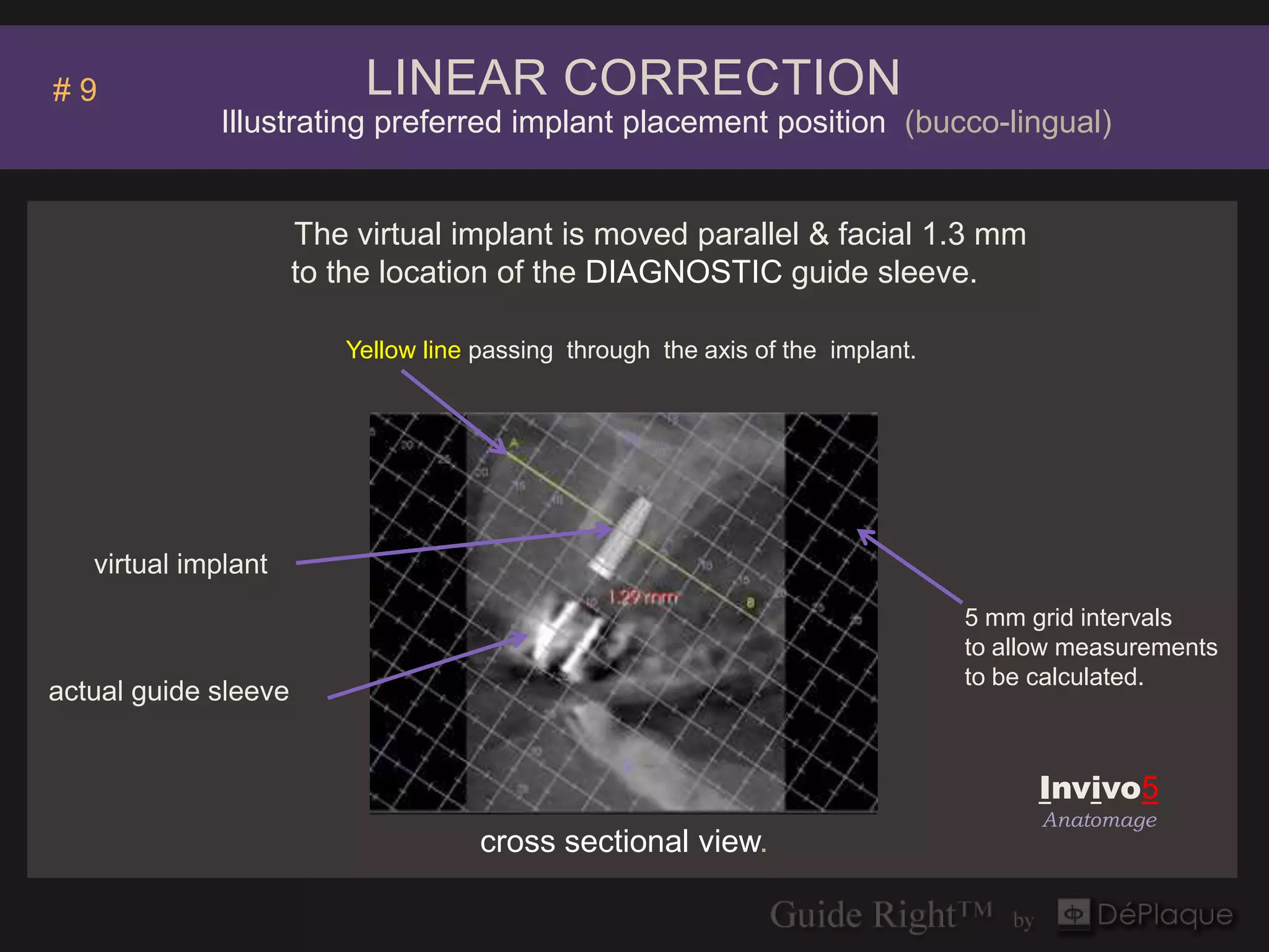 #9                         LINEAR CORRECTION
             Illustrating preferred implant placement position (bucco-lingual)


                      The virtual implant is moved parallel & facial 1.3 mm
                      to the location of the DIAGNOSTIC guide sleeve.

                         Yellow line passing through the axis of the implant.




   virtual implant
                                                                                5 mm grid intervals
                                                                                to allow measurements
                                                                                to be calculated.
actual guide sleeve


                                                                                      Invivo5
                                                                                      Anatomage
                                     cross sectional view.
 