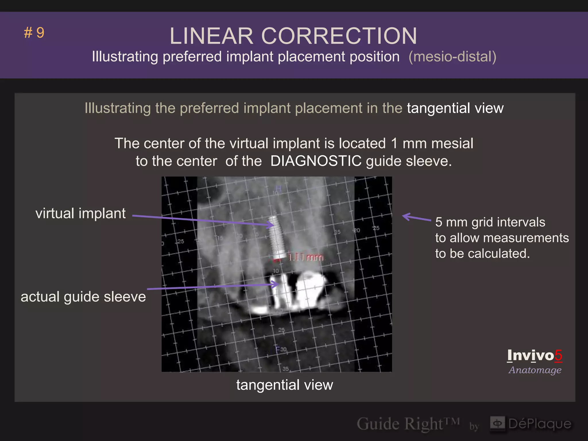 #9                     LINEAR CORRECTION
           Illustrating preferred implant placement position (mesio-distal)


          Illustrating the preferred implant placement in the tangential view

               The center of the virtual implant is located 1 mm mesial
                 to the center of the DIAGNOSTIC guide sleeve.


  virtual implant
                                                                  5 mm grid intervals
                                                                  to allow measurements
                                                                  to be calculated.


actual guide sleeve


                                                                                Invivo5
                                                                                Anatomage
                                  tangential view
 