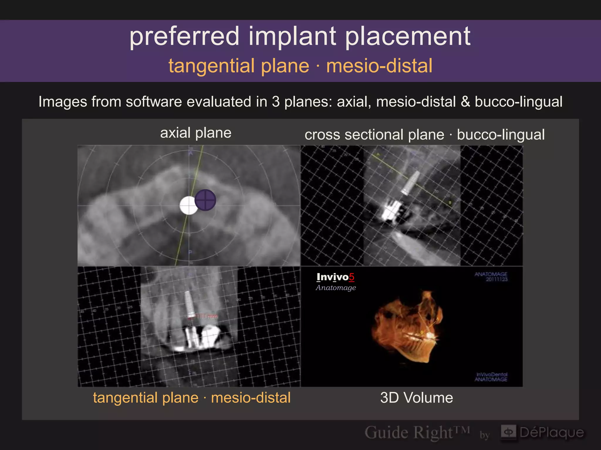 preferred implant placement
                   tangential plane · mesio-distal
Images from software evaluated in 3 planes: axial, mesio-distal & bucco-lingual

                  axial plane             cross sectional plane · bucco-lingual




                                           Invivo5
                                           Anatomage




        tangential plane · mesio-distal                3D Volume
 