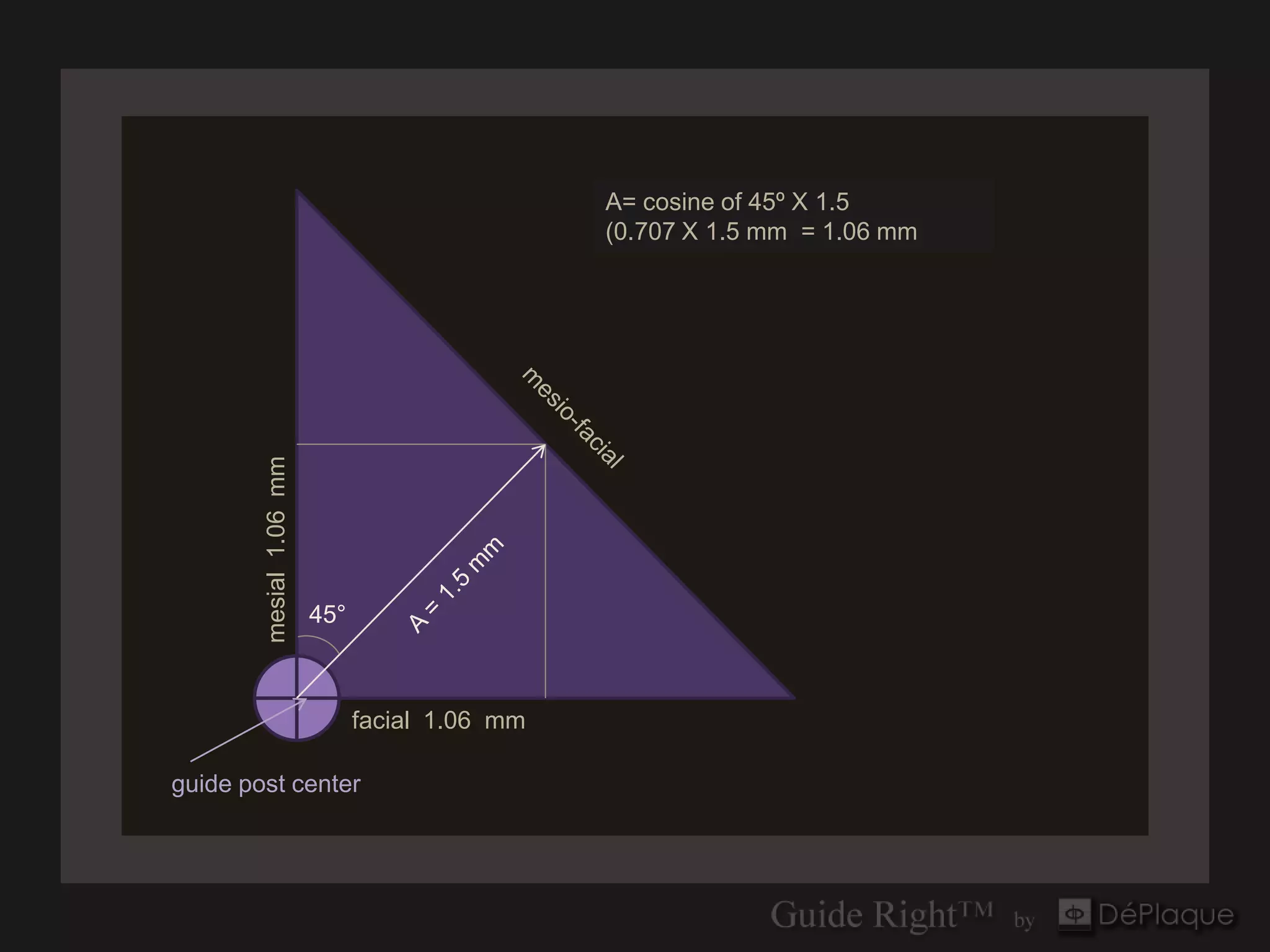 A= cosine of 45º X 1.5
                                                (0.707 X 1.5 mm = 1.06 mm
        mesial 1.06 mm




                         45°


        45°
                               facial 1.06 mm

guide post center
 