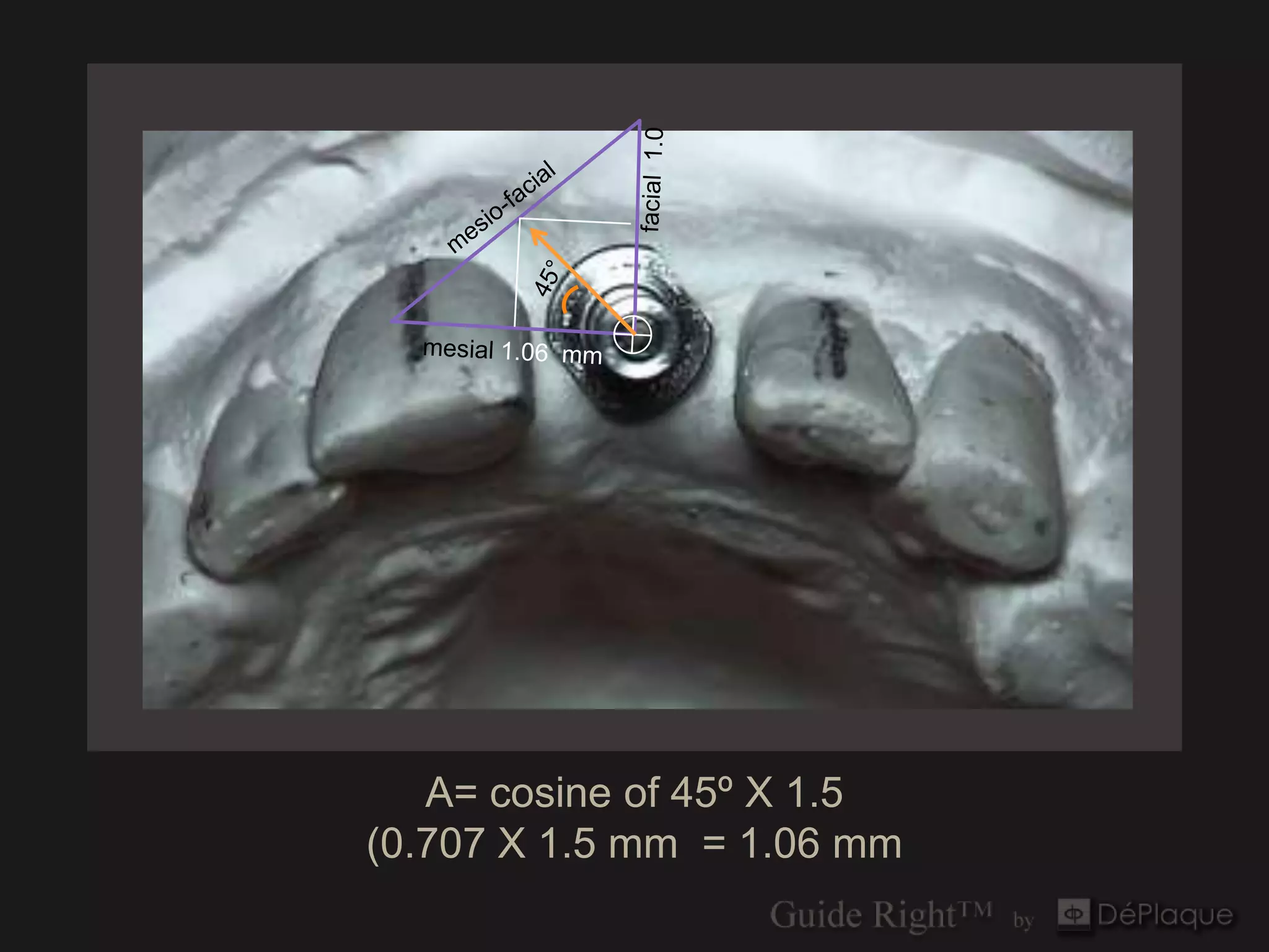 A= cosine of 45º X 1.5
(0.707 X 1.5 mm = 1.06 mm
 