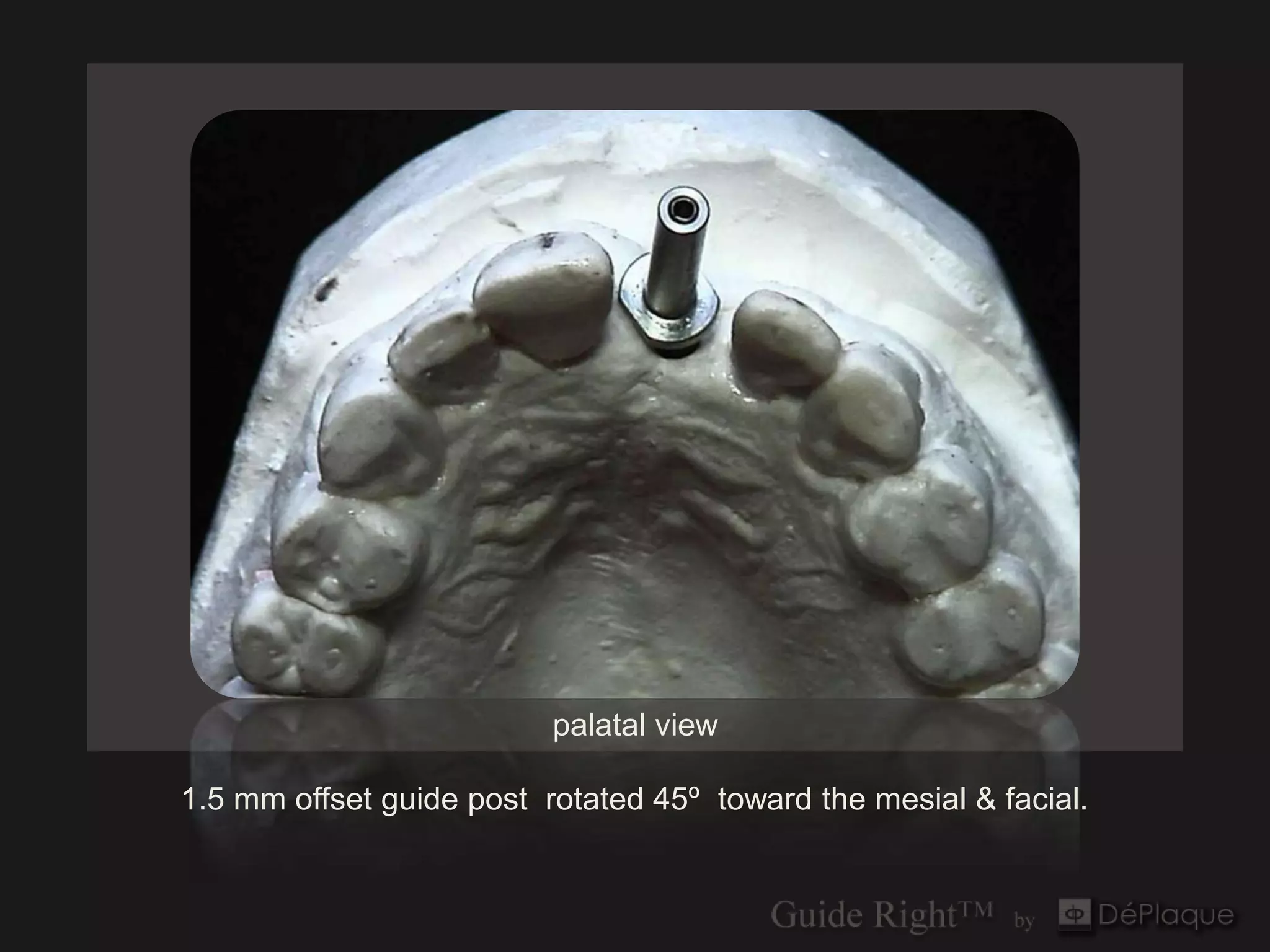 palatal view

1.5 mm offset guide post rotated 45º toward the mesial & facial.
 