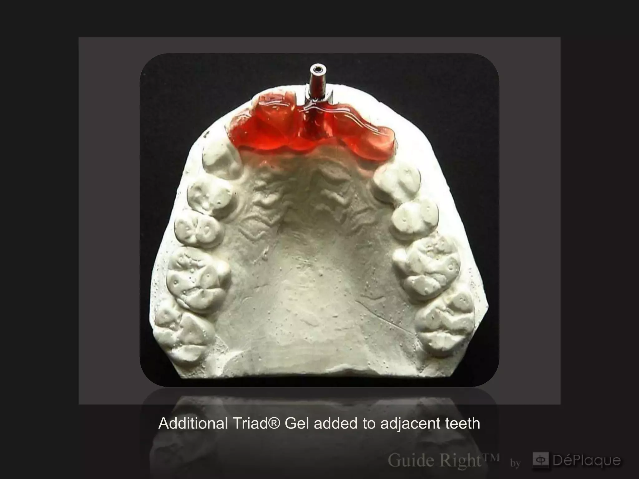Additional Triad® Gel added to adjacent teeth
 