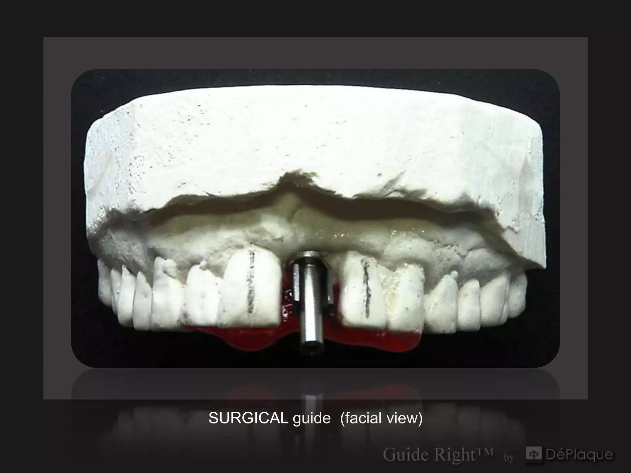 SURGICAL guide (facial view)
 