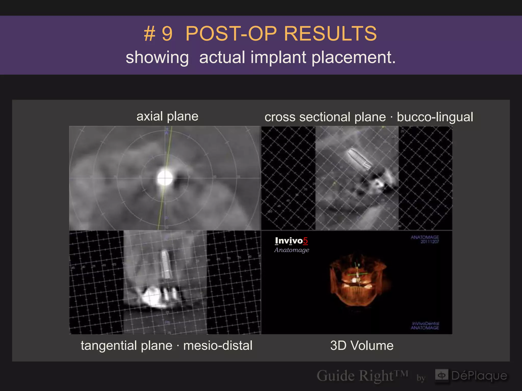 # 9 POST-OP RESULTS
        showing actual implant placement.


          axial plane             cross sectional plane · bucco-lingual




                                   Invivo5
                                   Anatomage




tangential plane · mesio-distal                3D Volume
 