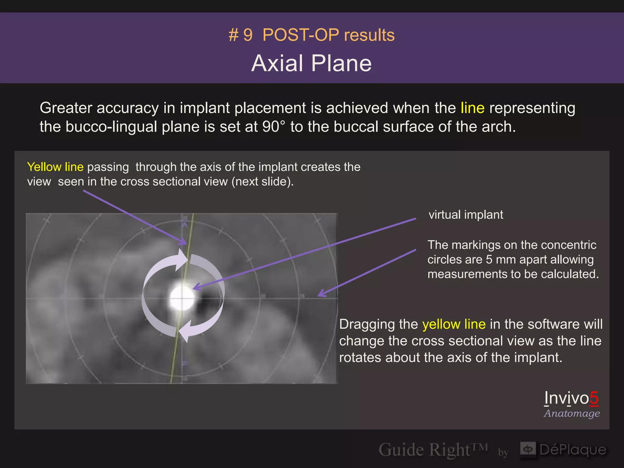 # 9 POST-OP results
                                          Axial Plane
  Greater accuracy in implant placement is achieved when the line representing
  the bucco-lingual plane is set at 90° to the buccal surface of the arch.

Yellow line passing through the axis of the implant creates the
view seen in the cross sectional view (next slide).

                                                                         virtual implant

                                                                         The markings on the concentric
                                                                         circles are 5 mm apart allowing
                                                                         measurements to be calculated.



                                                          Dragging the yellow line in the software will
                                                          change the cross sectional view as the line
                                                          rotates about the axis of the implant.


                                                                                              Invivo5
                                                                                             Anatomage
 