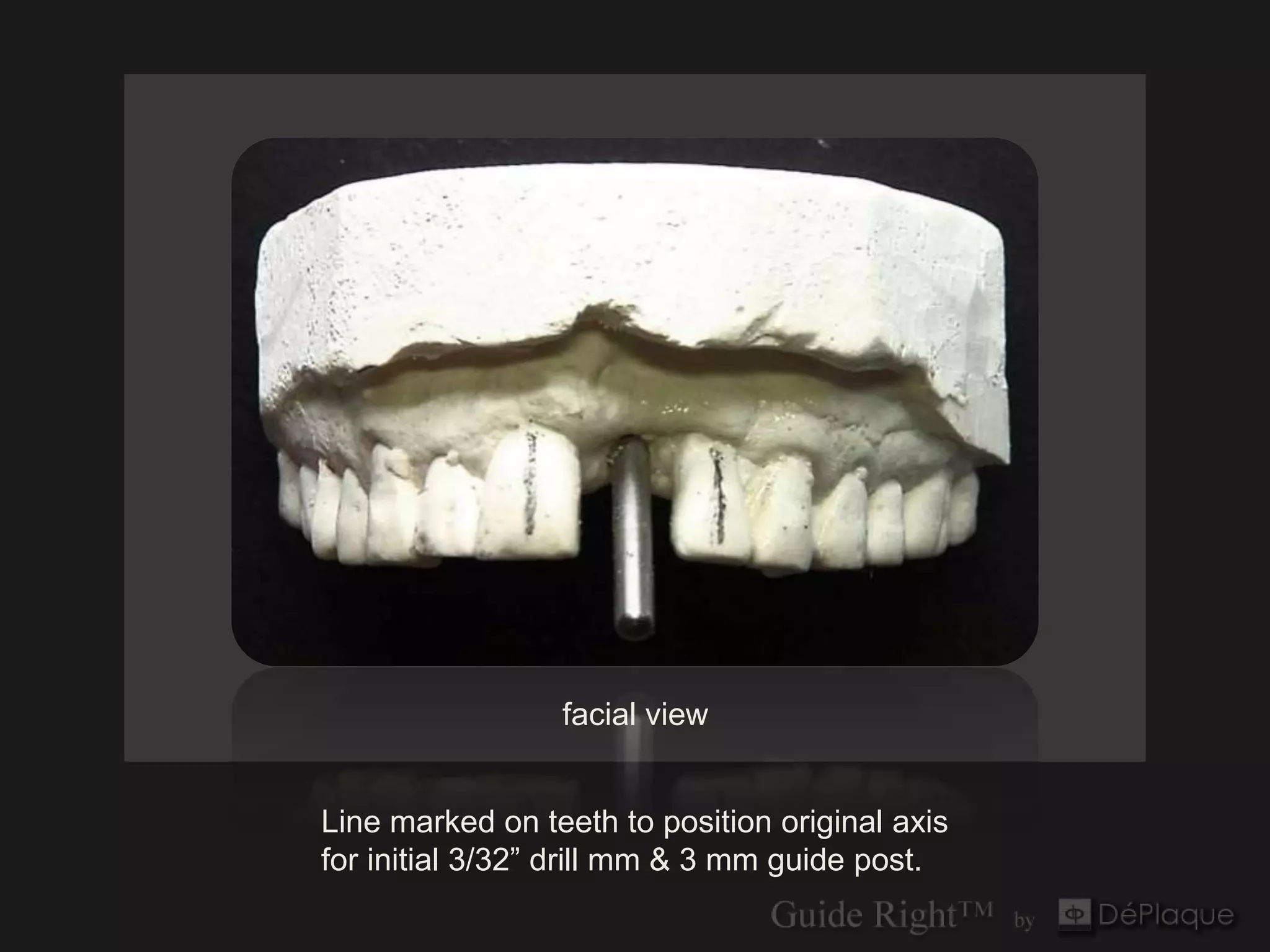 facial view


Line marked on teeth to position original axis
for initial 3/32” drill mm & 3 mm guide post.
 