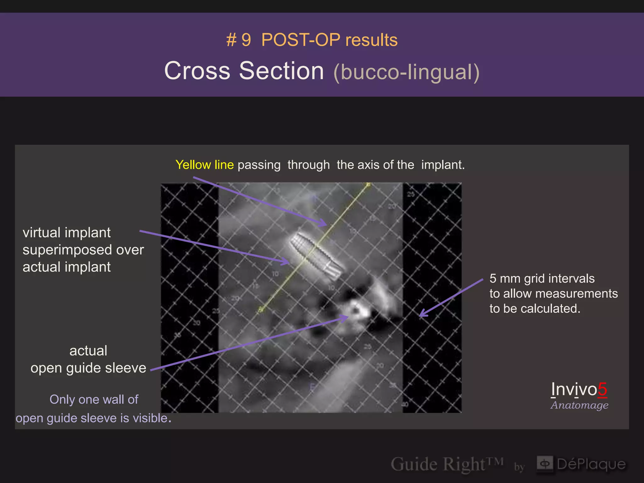 # 9 POST-OP results
                           Cross Section (bucco-lingual)


                                Yellow line passing through the axis of the implant.




 virtual implant
 superimposed over
 actual implant
                                                                                       5 mm grid intervals
                                                                                       to allow measurements
                                                                                       to be calculated.


       actual
  open guide sleeve

     Only one wall of
                                                                                                Invivo5
                                                                                                Anatomage
open guide sleeve is visible.
 