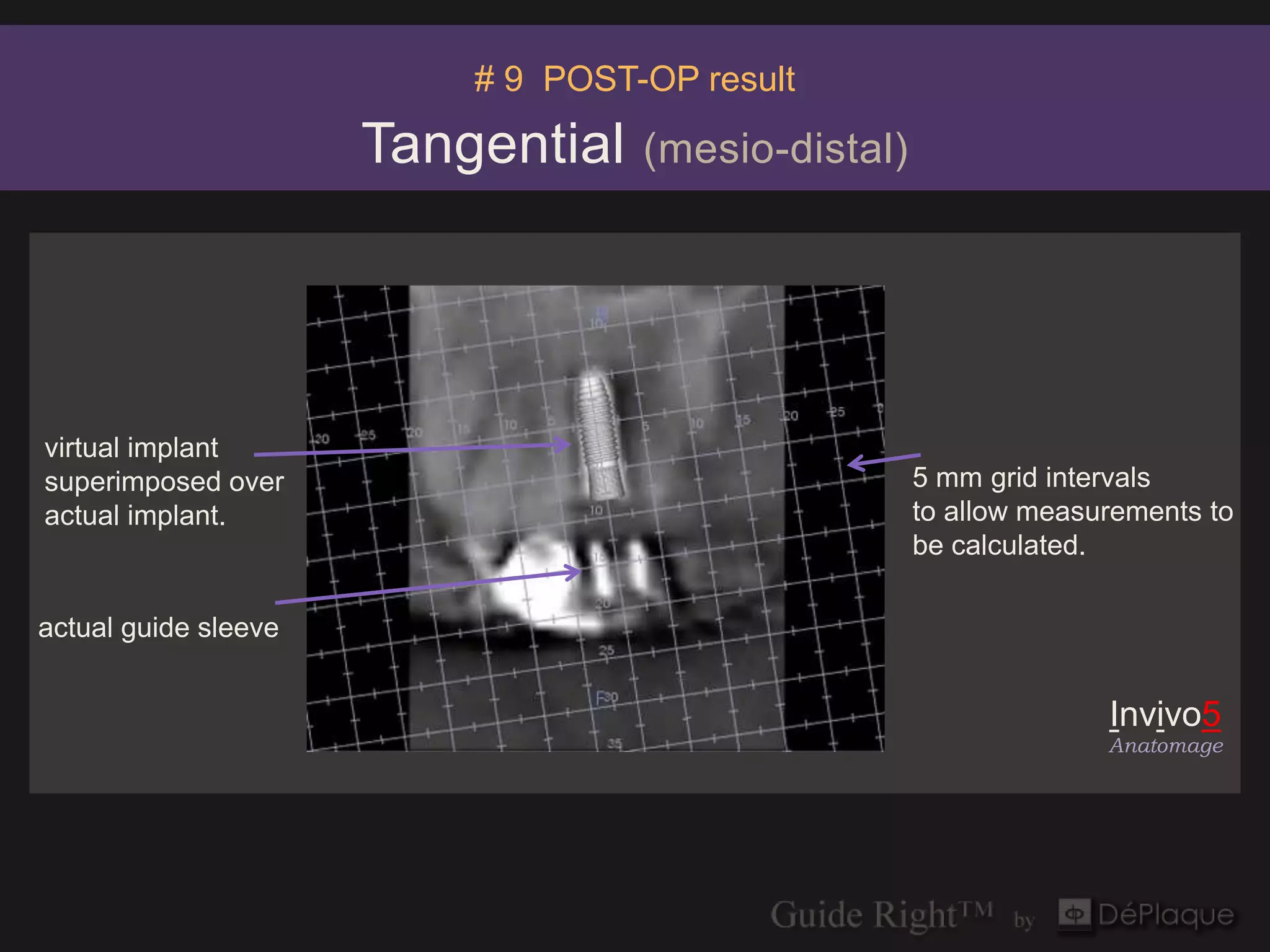 # 9 POST-OP result

                      Tangential   (mesio-distal)




virtual implant
superimposed over                                   5 mm grid intervals
actual implant.                                     to allow measurements to
                                                    be calculated.

actual guide sleeve


                                                                  Invivo5
                                                                  Anatomage
 