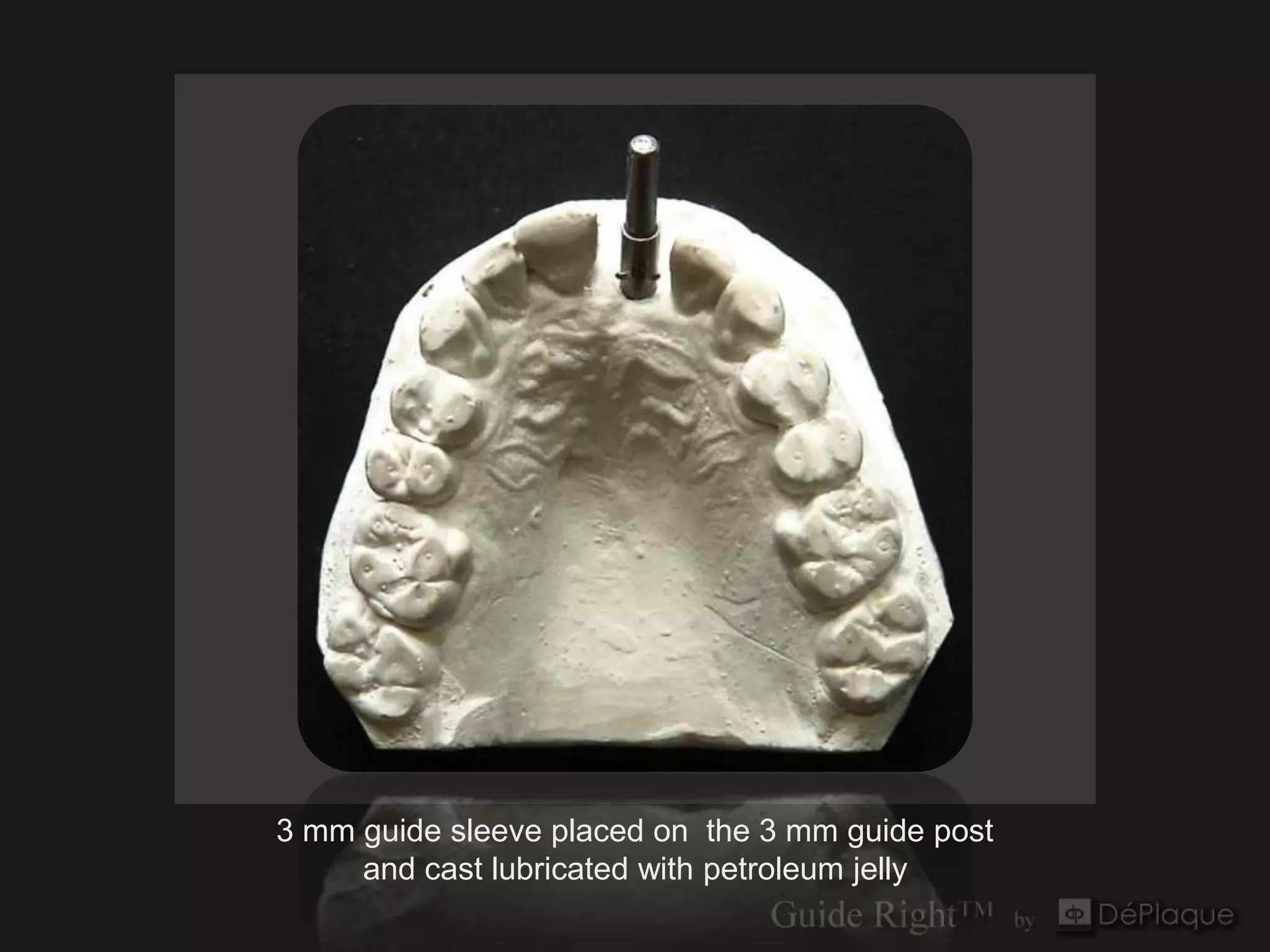 3 mm guide sleeve placed on the 3 mm guide post
     and cast lubricated with petroleum jelly
 