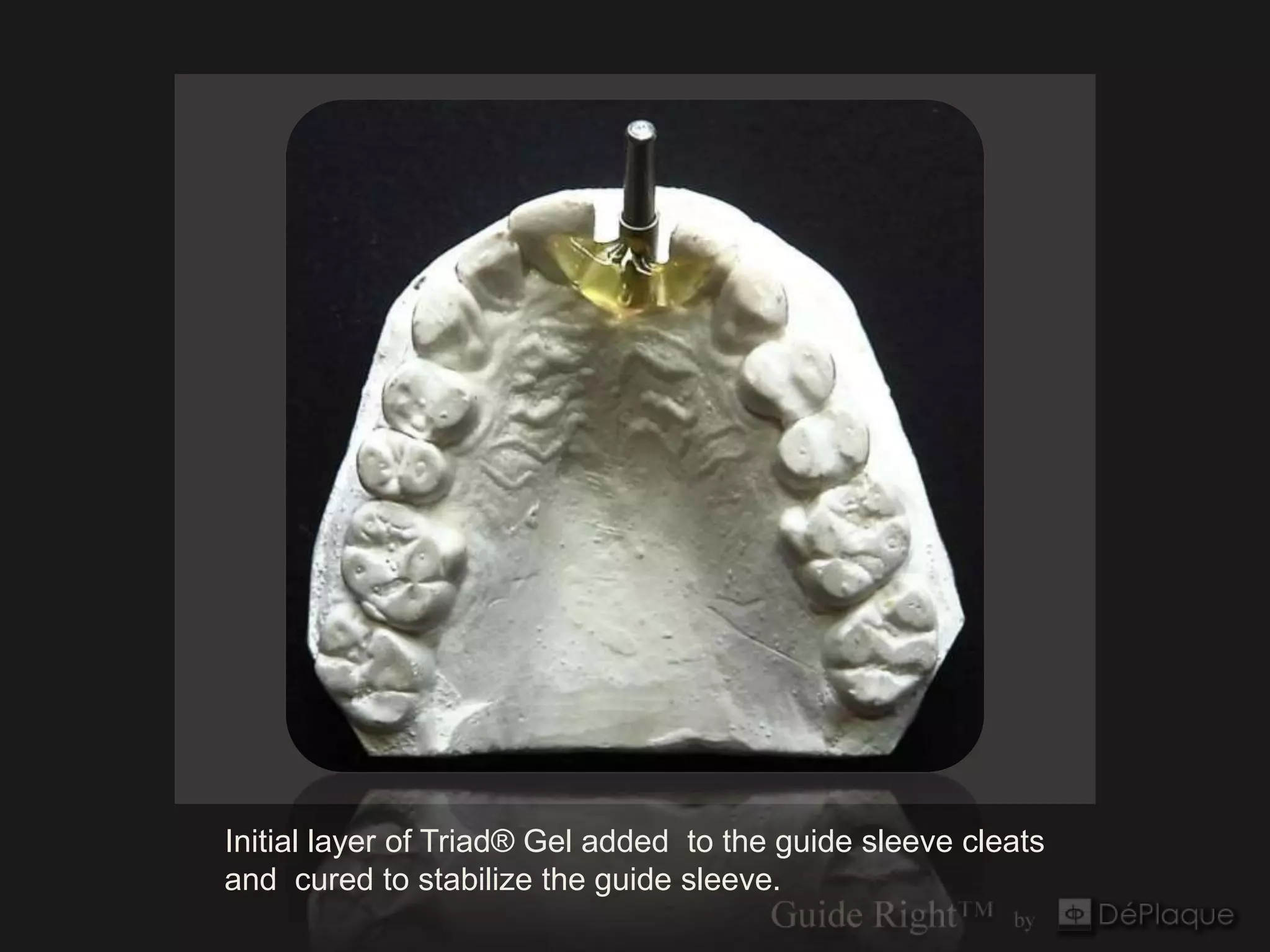 Initial layer of Triad® Gel added to the guide sleeve cleats
and cured to stabilize the guide sleeve.
 