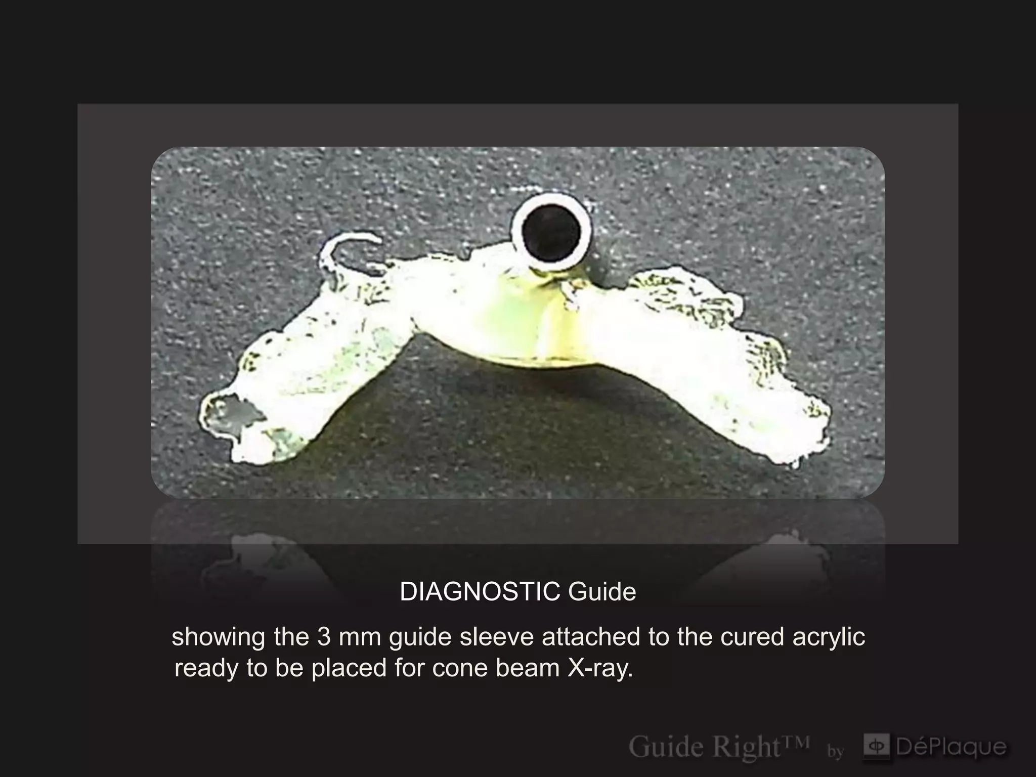 DIAGNOSTIC Guide
showing the 3 mm guide sleeve attached to the cured acrylic
ready to be placed for cone beam X-ray.
 
