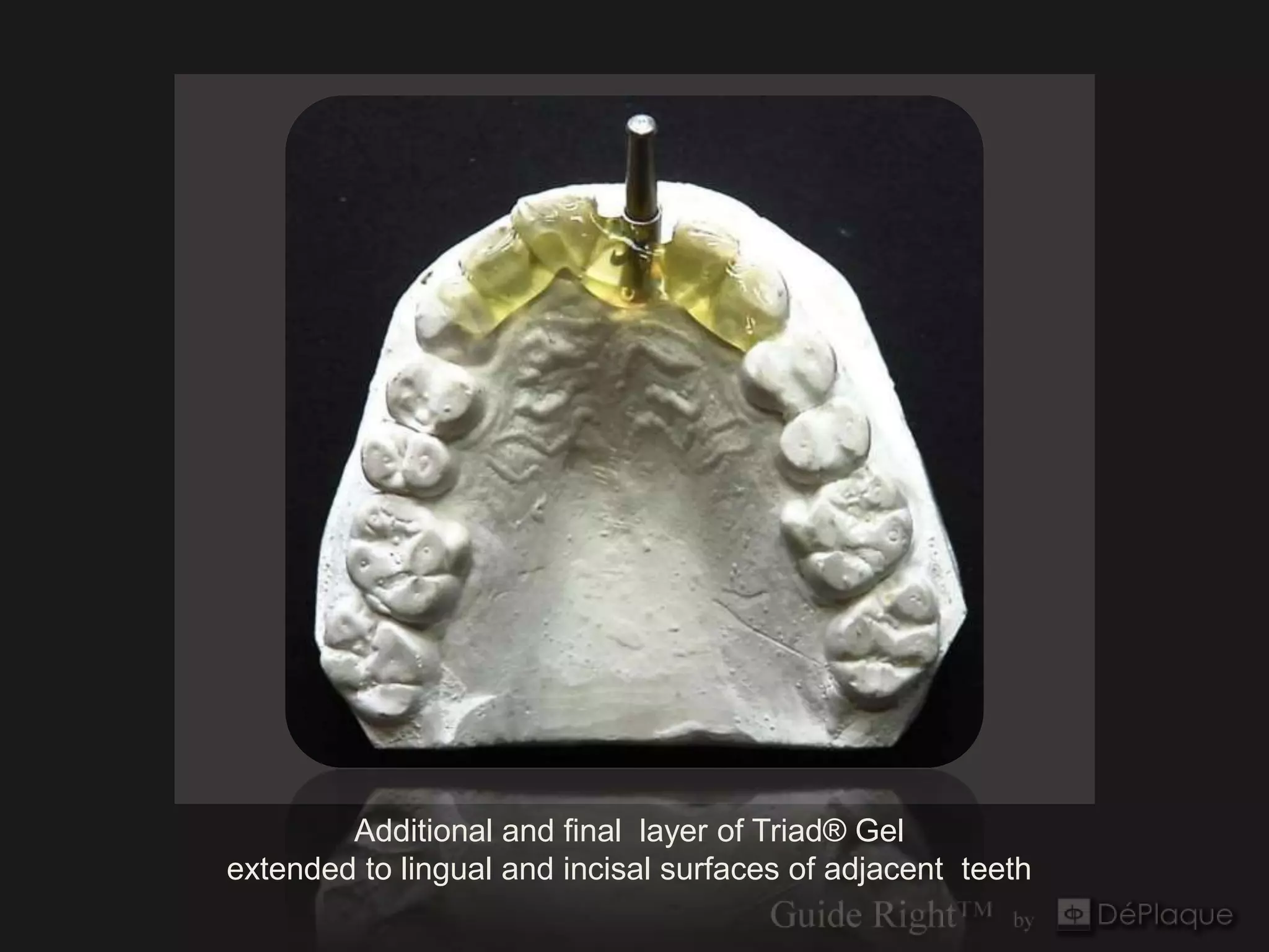 Additional and final layer of Triad® Gel
extended to lingual and incisal surfaces of adjacent teeth
 