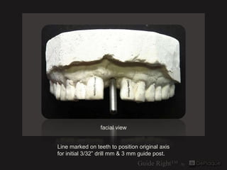 facial view


Line marked on teeth to position original axis
for initial 3/32” drill mm & 3 mm guide post.
 