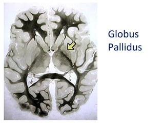 Globus
Pallidus
 