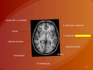 112
n. lenticular. putamen
n. lenticular. globus palidus
cápsula interna
tálamo
cabeza del n. caudado
ínsula
cápsula extrema
hipocampo
III venterículo
 