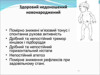 Здоровий недоношений новонароджений Помірно знижені м’язовий тонус і спонтанна рухова активність Дрібний та непостійний тремор кінцівок і підборіддя Дрібний та непостійний горизонтальний ністагм Непостійний атетоз Помірне зниження рефлексів при задовільному стані. 