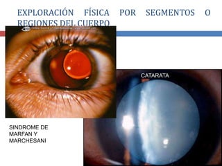 EXPLORACIÓN FÍSICA POR SEGMENTOS O
REGIONES DEL CUERPO
CATARATA
SINDROME DE
MARFAN Y
MARCHESANI
 