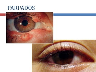 PARPADOS
 