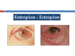 Entropion - Ectropion
 