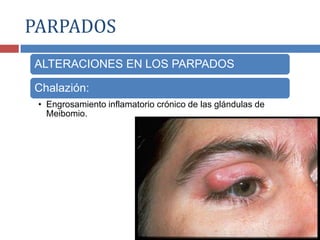 ALTERACIONES EN LOS PARPADOS
Chalazión:
• Engrosamiento inflamatorio crónico de las glándulas de
Meibomio.
PARPADOS
 