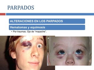 ALTERACIONES EN LOS PARPADOS
Hematomas y equímosis
• Por traumas. Ojo de “mapache”.
PARPADOS
 