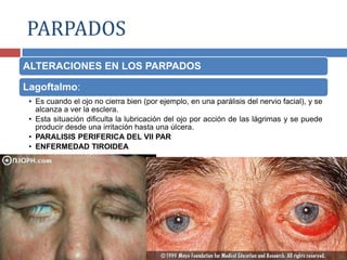 ALTERACIONES EN LOS PARPADOS
Lagoftalmo:
• Es cuando el ojo no cierra bien (por ejemplo, en una parálisis del nervio facial), y se
alcanza a ver la esclera.
• Esta situación dificulta la lubricación del ojo por acción de las lágrimas y se puede
producir desde una irritación hasta una úlcera.
• PARALISIS PERIFERICA DEL VII PAR
• ENFERMEDAD TIROIDEA
PARPADOS
 
