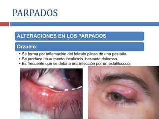 ALTERACIONES EN LOS PARPADOS
Orzuelo:
• Se forma por inflamación del folículo piloso de una pestaña.
• Se produce un aumento localizado, bastante doloroso.
• Es frecuente que se deba a una infección por un estafilococo.
PARPADOS
 