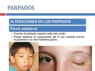 ALTERACIONES EN LOS PARPADOS
Ptosis palpebral:
• Cuando el párpado superior está más caído.
• Puede deberse al compromiso del III par craneal (nervio
oculomotor) o a una miastenia gravis.
PARPADOS
 