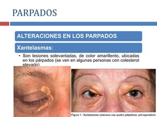 ALTERACIONES EN LOS PARPADOS
Xantelasmas:
• Son lesiones solevantadas, de color amarillento, ubicadas
en los párpados (se ven en algunas personas con colesterol
elevado)
PARPADOS
 