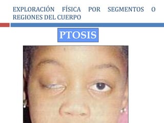 PTOSIS
EXPLORACIÓN FÍSICA POR SEGMENTOS O
REGIONES DEL CUERPO
 