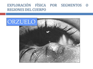 ORZUELO
EXPLORACIÓN FÍSICA POR SEGMENTOS O
REGIONES DEL CUERPO
 