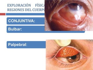 CONJUNTIVA:
Bulbar:
Palpebral:
EXPLORACIÓN FÍSICA POR SEGMENTOS O
REGIONES DEL CUERPO
 