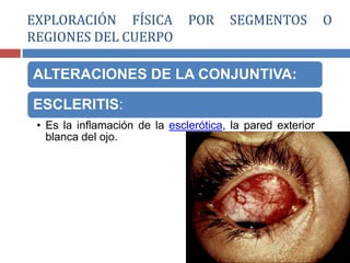 ALTERACIONES DE LA CONJUNTIVA:
ESCLERITIS:
• Es la inflamación de la esclerótica, la pared exterior
blanca del ojo.
EXPLORACIÓN FÍSICA POR SEGMENTOS O
REGIONES DEL CUERPO
 