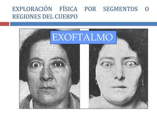 EXOFTALMO
EXPLORACIÓN FÍSICA POR SEGMENTOS O
REGIONES DEL CUERPO
 
