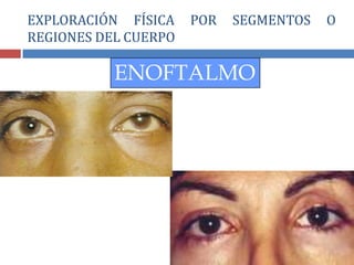 ENOFTALMO
EXPLORACIÓN FÍSICA POR SEGMENTOS O
REGIONES DEL CUERPO
 