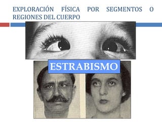 ESTRABISMO
EXPLORACIÓN FÍSICA POR SEGMENTOS O
REGIONES DEL CUERPO
 