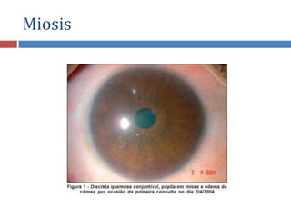 Miosis
 