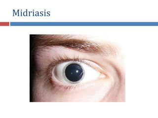 Midriasis
 