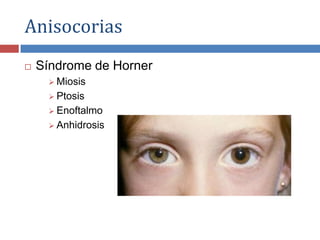 Anisocorias
 Síndrome de Horner
 Miosis
 Ptosis
 Enoftalmo
 Anhidrosis
 