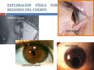 EXPLORACIÓN FÍSICA POR SEGMENTOS O
REGIONES DEL CUERPO
MICROFAQUIA
ESFEROFAQUIA
LENTICONO
COLOBOMA
 