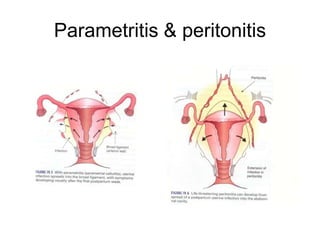 Parametritis & peritonitis

 
