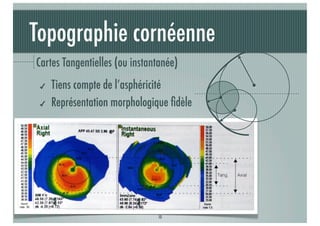 Topographie cornéenne
Cartes Tangentielles (ou instantanée)
✔
✔

Tiens compte de l’asphéricité
Représentation morphologique ﬁdèle

J-A.DOUAUD - ISO Bordeaux - 2013/2014

10

 
