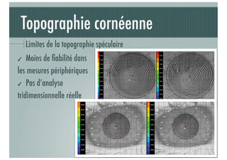 Topographie cornéenne
Limites de la topographie spéculaire
Moins de ﬁabilité dans
les mesures périphériques
✔ Pas d’analyse
tridimensionnelle réelle
✔

J-A.DOUAUD - ISO Bordeaux - 2013/2014

13

 