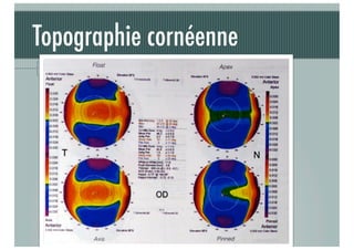 Topographie cornéenne
Topographie d'élévation : modes

J-A.DOUAUD - ISO Bordeaux - 2013/2014

21

 